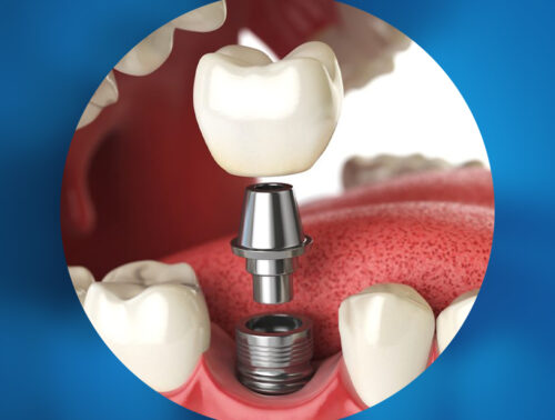 implant_dentar